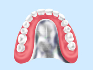 金属床義歯