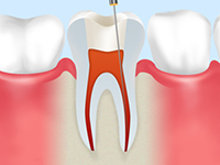 根っこから治す「根管治療」