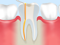 根っこから治す「根管治療」