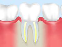 根っこから治す「根管治療」