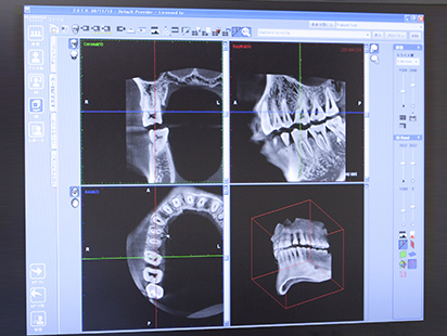 より正確な診断を行うために～歯科用CTの活用～