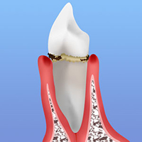 歯周病はどんな病気？