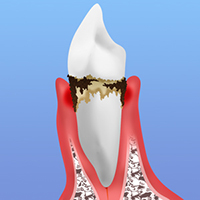 歯周病はどんな病気？