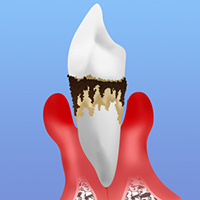 歯周病はどんな病気？